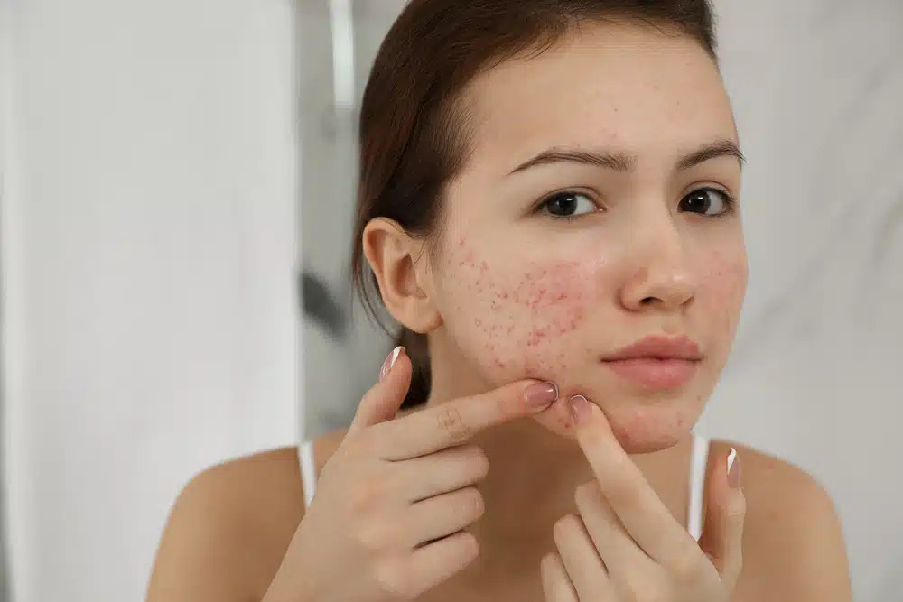 Identifying-and-Treating-Every-Breakout-Acne