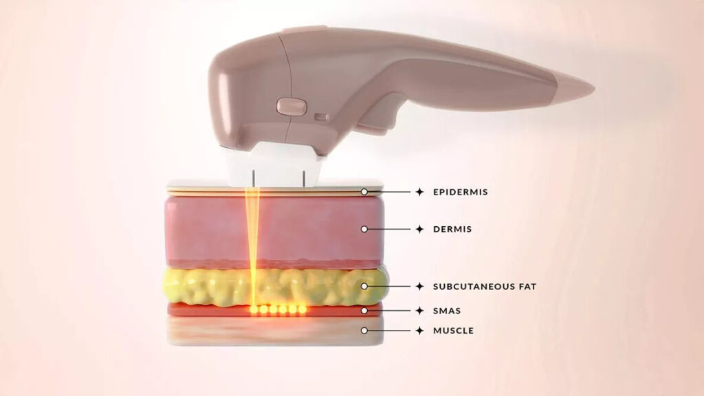 What-is-HIFU-Ultraformer-III