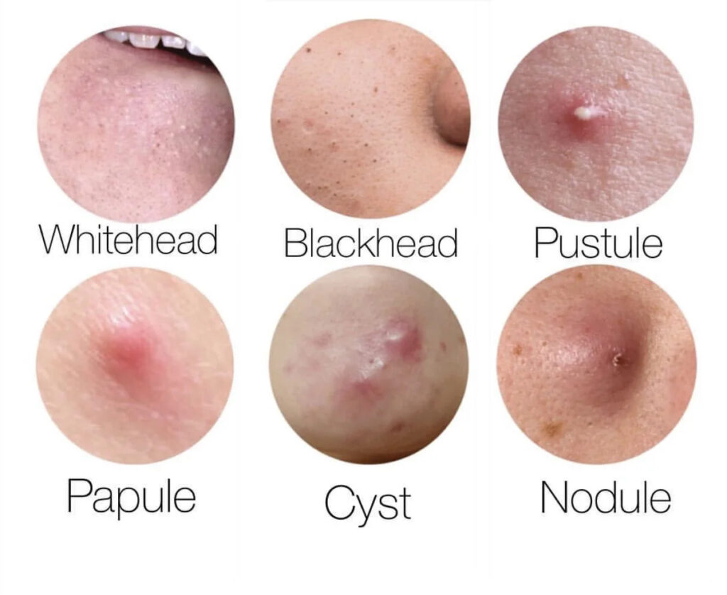 types-of-acne